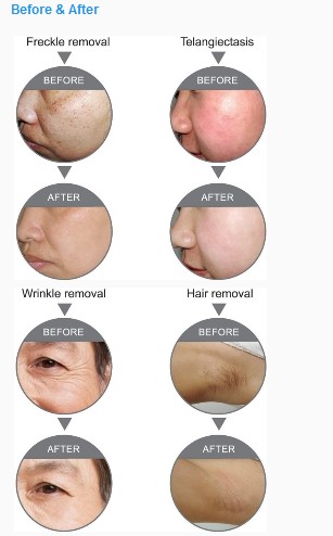 LT-E3 - E Light Bipolar Radio Frequency Rf Ipl Skin Lifting Spa - mychway