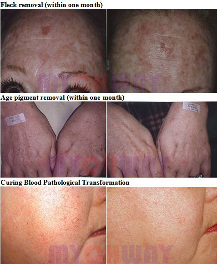 LT-EL450C - Elight Ipl Laser Rf Skin Rejuvenation Hair Acne Removal - mychway LT-EL450C - Elight Ipl Laser Rf Skin Rejuvenation Hair Acne Removal - mychway