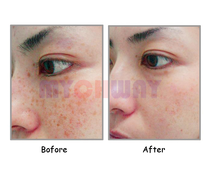 LT-HF102 - Ipl Skin Rejuvenation Hair Spots Fleck Removal Machine - mychway