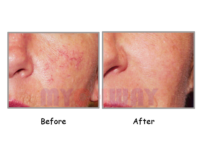 LT-HF601 - E-light Ipl Hair Removal Skin Rejuvenation Rf Slimming - mychway LT-HF601 - E-light Ipl Hair Removal Skin Rejuvenation Rf Slimming - mychway