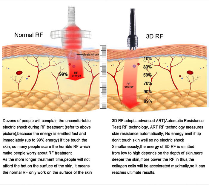 3D Radio Frequency Comfortable&Warmful Quadrupole 3D RF ...