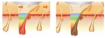 SPTF2000 - Skin Rejuvenati​on Hair Removal System Ipl Beauty Spa - mychway
