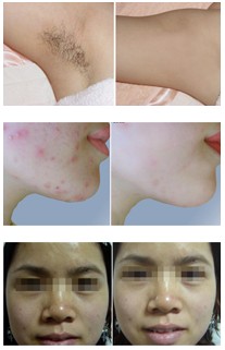 SPTF2000 - Skin Rejuvenati​on Hair Removal System Ipl Beauty Spa - mychway