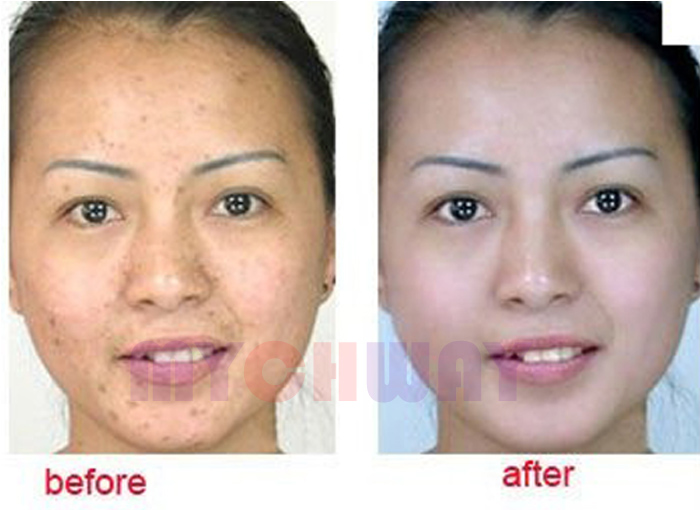 SR-SPA5 - Vacuum Sunction Therapy Skin Tender Spa Salon Bio Spray - mychway SR-SPA5 - Vacuum Sunction Therapy Skin Tender Spa Salon Bio Spray - mychway