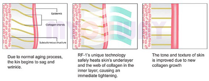 WL-RF618 - New Beauty Equipment Rf Slimming Ultrasonic Liposuction - mychway WL-RF618 - New Beauty Equipment Rf Slimming Ultrasonic Liposuction - mychway