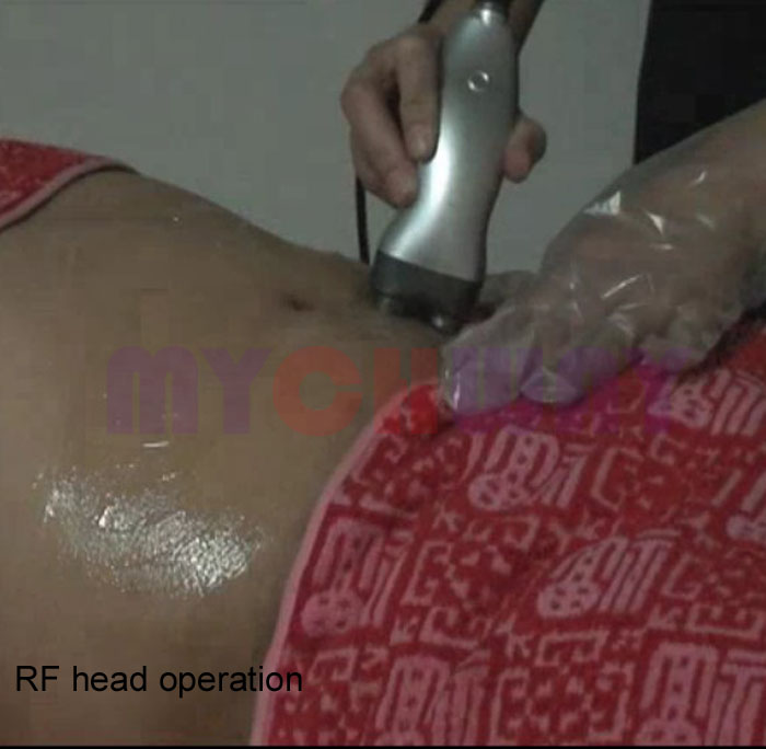 WL-RU2 - Ultrasonic Liposuction Cavitation Tripolar Bipolar - mychway