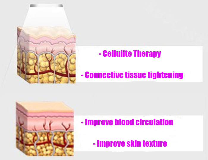 WL-SE01 - Ultrasonic Cavitation Non Surgical Liposuction Body Spa - mychway