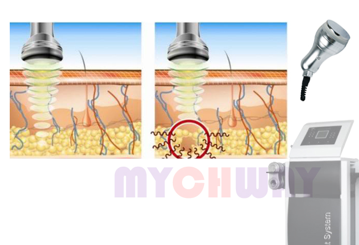 WL-UL6 - Liposuction Cavitation Bipolar Radio Frequency Machine - mychway