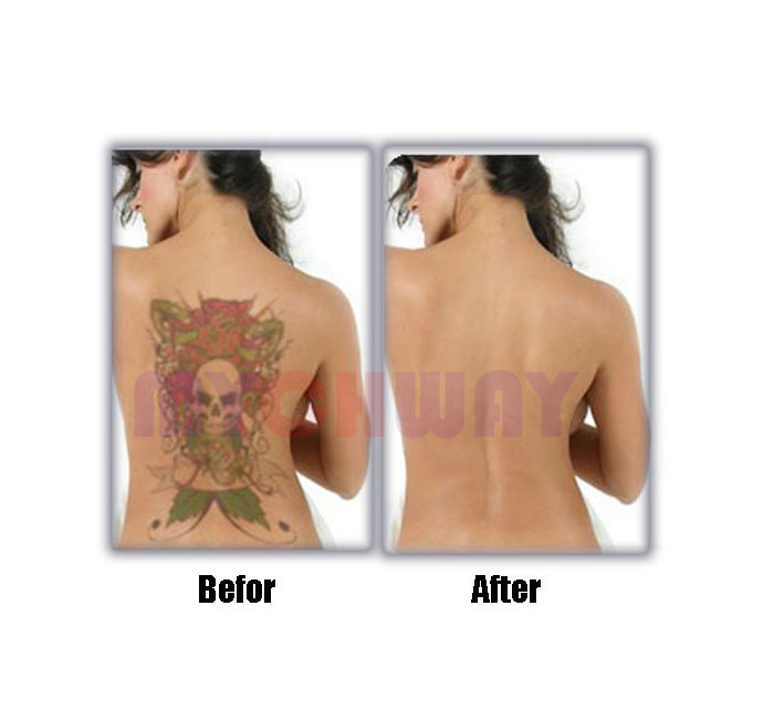 cavitation slimming system lw 101 before and after