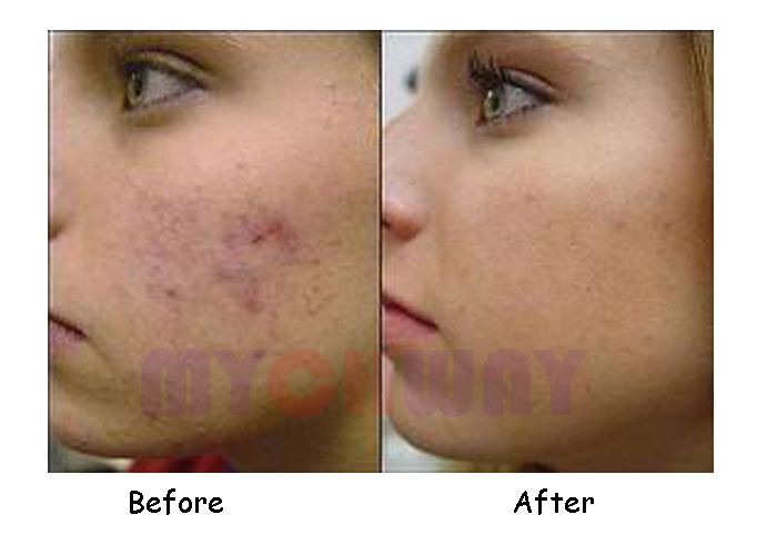LT-IC330A] Buy Pro IPL Laser Skin Rejuvenation Hair Acne Fleck Removal ...