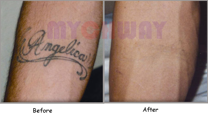 [LT-MV4500] Buy YAG Laser Tattoos Eyebrow Freckle Nevus 